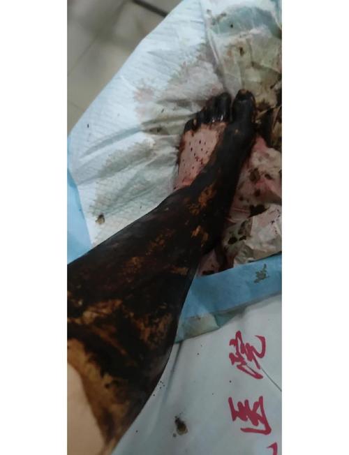新澳今天最新资料大全和被蛇咬两年仍后遗症与被蛇咬了几年后身体有毒素吗
